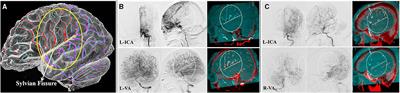 Analyzing characteristics of collateral flow to parasylvian cortical arteries by three-dimensional digital subtraction angiography–magnetic resonance angiography fusion imaging in adult moyamoya disease